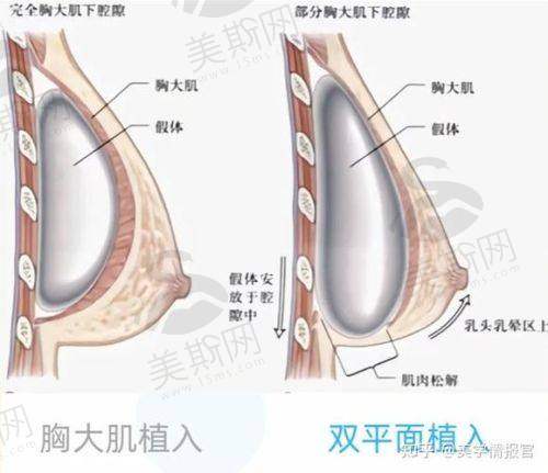 杭州凯丽国内外隆胸是什么材质