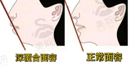 假体隆胸的利弊与恢复情况大揭秘，包膜挛缩症状、取出费用及术后胸部样子全知晓！ 