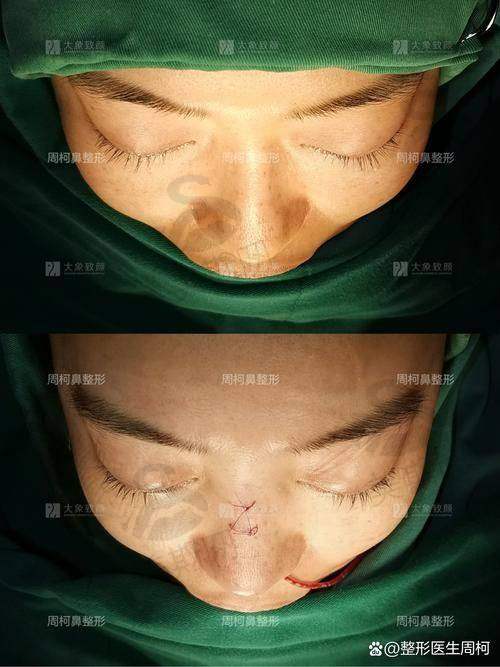 实例3:“修复失败鼻,终于找到自然款医生!”——32岁宝妈 张姐