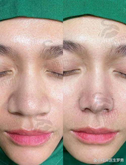 谢立宁医生团队实力解析:日本九州大学博士领衔的鼻整形骨干医生团