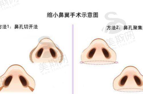 3.4 操作流程:4步完成自然美鼻