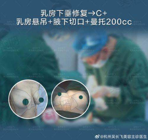 北京华韩整形医院谢立宁博士假体胸部整形术预约流程