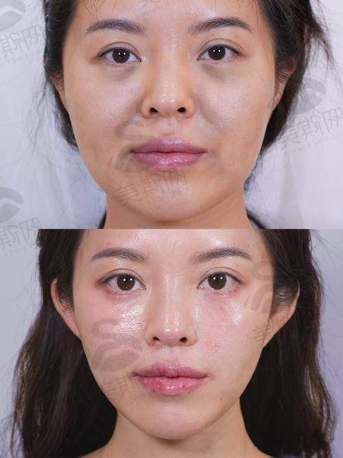 北京王阔远怎么样?总结:“馒化脸”患者的“靠谱之选”