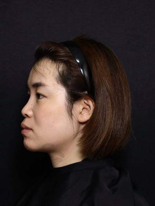 陈小平医生磨骨技术为什么这么火?3大核心优势让他成为“磨骨天花板”!