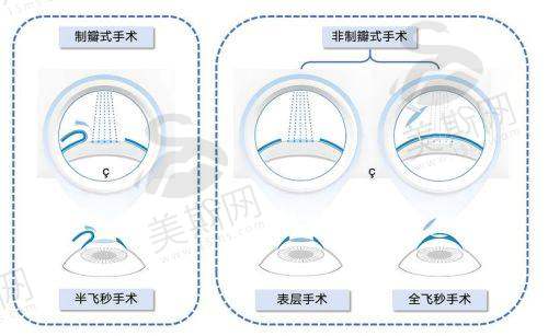 北京同仁眼科哪个医生好?白内障手术找这两位“圣手”,飞秒技术切口仅0.1mm!