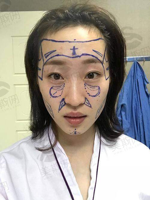 北京王阔远怎么样？三维吸脂与筋膜提升技术硬，超2000例馒化修复口碑佳靠谱