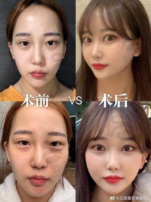 王阔远馒化修复实例:2000+例实证,从“膨胀”到“精致”的逆袭