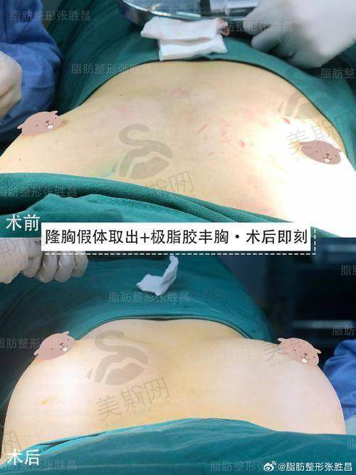(三)胸部修复项目价格