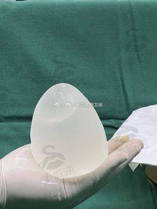 北京华韩整形医院谢立宁博士假体胸部整形术真实口碑实例