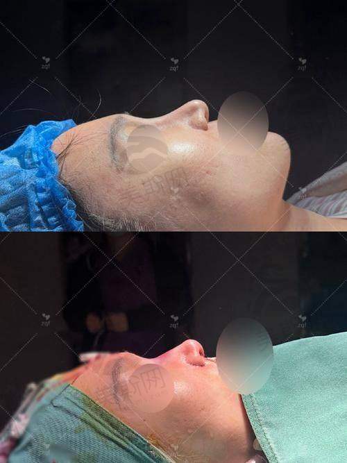 实例2:“谢博士调整的鼻唇角,笑起来太灵动了!”——28岁教师 小雅