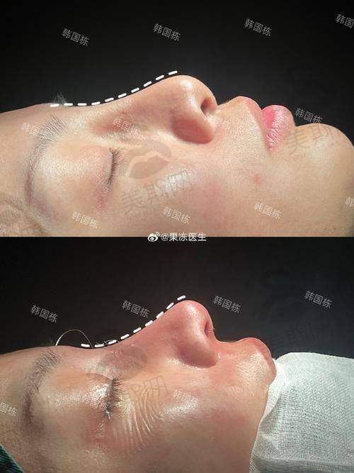 真实用户实例反馈:谢立宁常规鼻综合术后成效如何?