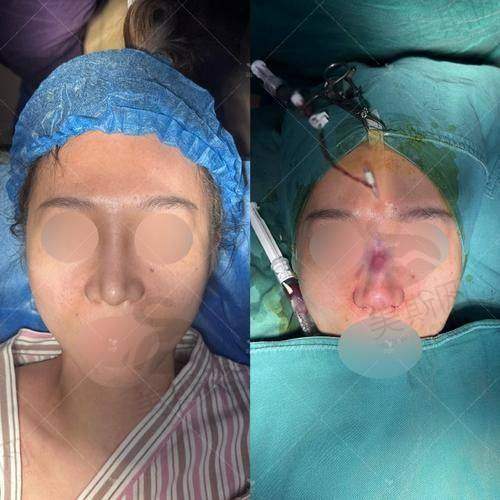 3.2 材料优势:进口假体+生物材料,兼顾安心与成效