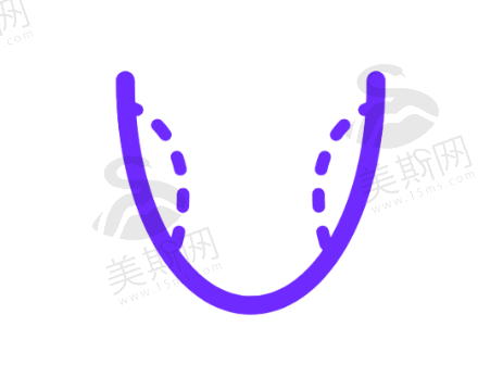 假体隆胸取出后胸部是什么样子的