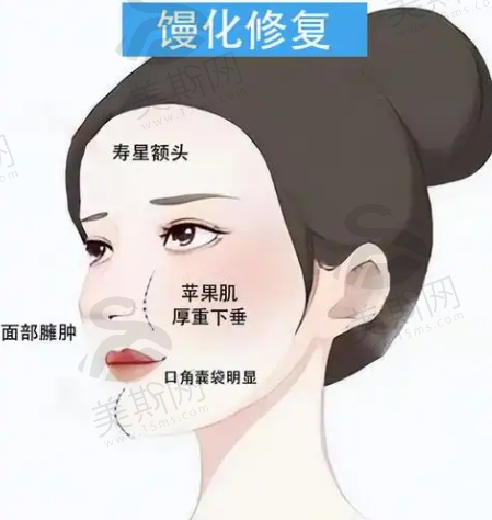北京王阔远医术评价高！2000+馒化修复案例实证，分层识别与逆向修复打造面部减容教科书