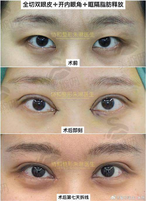 眼综合整形项目真相