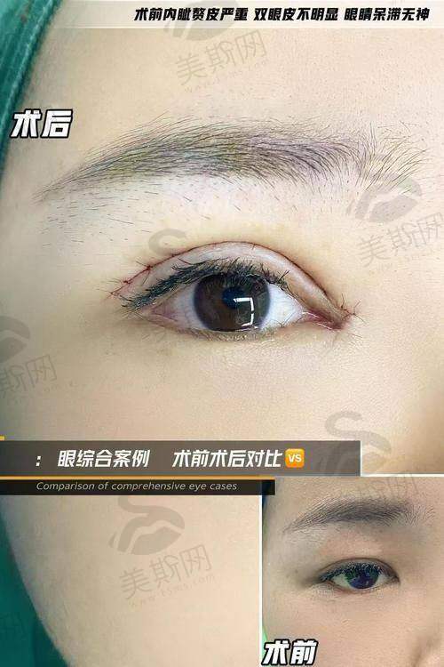 面部整形手术术前术后避坑指南