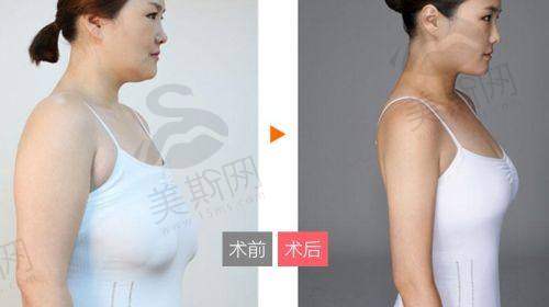 宁波市解放军 医院隆鼻项目剖析