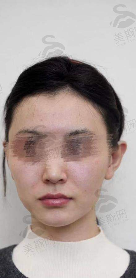 哪些人适合做双面网兜提升术