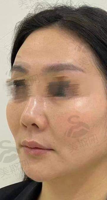 选择双面网兜提升术的关键要点