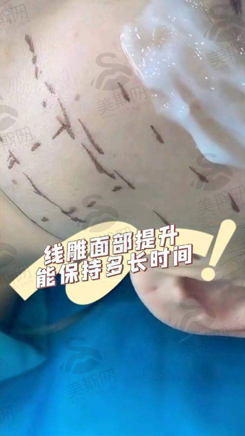 双面网兜提升术成效能维持多久