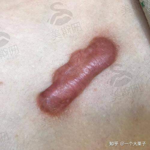 植皮手术项目真相