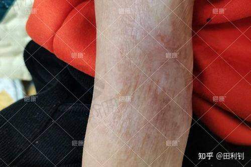 植皮手术关键选择点