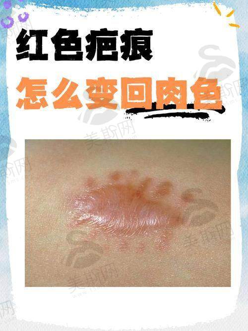 成都植皮手术医院哪家好？华西医院、省人民医院整形科凭借专业技术与优质服务值得选择！ 