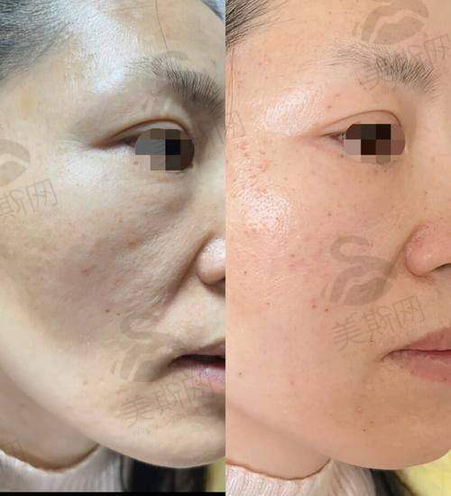 超声炮十天后对比照片展示价格贵吗？不贵！单次3000-5000元起，套餐低至8000元起！ 