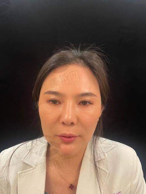 四川华 西拉皮手术相关实例及口碑