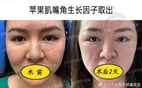 上海沪中王洪会取生长因子吗
