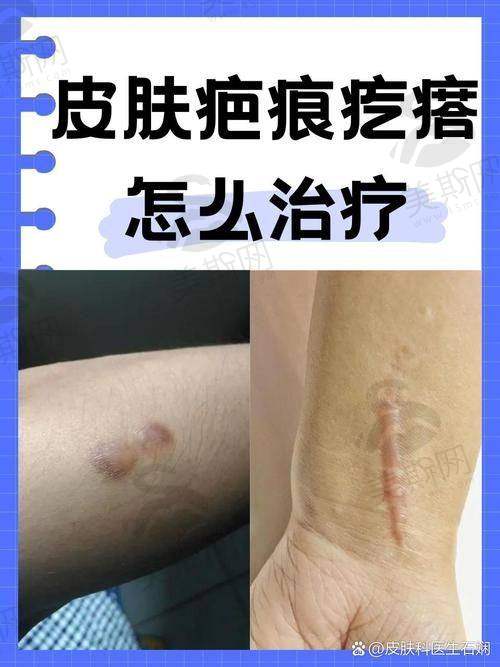 南京祛疤痕大概多少钱？小面积约1000 - 3000元起，大面积约5000 - 10000元起，南京肤康等医院可参考！ 
