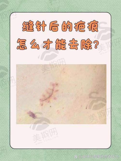 南京祛疤痕术前术后避坑指南