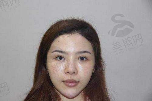 彭鑫医生做鼻子的术前术后避坑指南