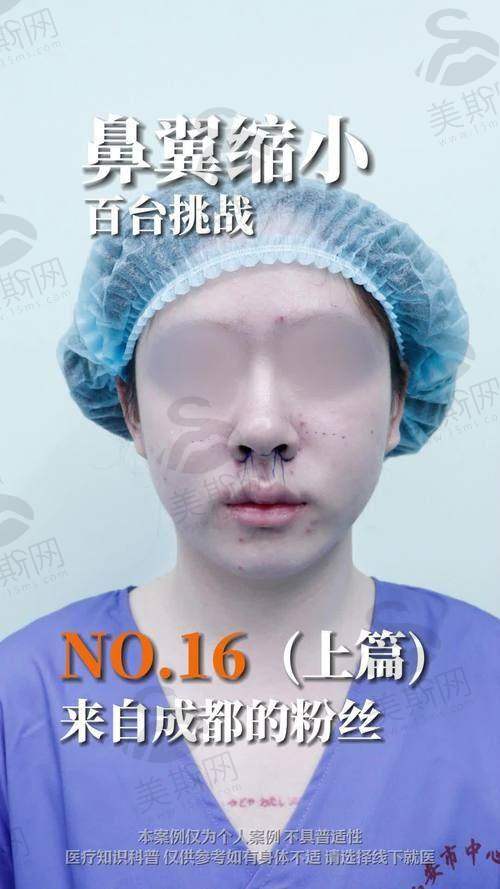 彭鑫医生做鼻子的口碑实例