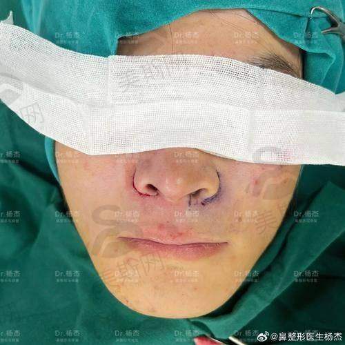 彭鑫医生做鼻子好吗？当然好！个性化设计、精细化操作，隆鼻技术超厉害！ 