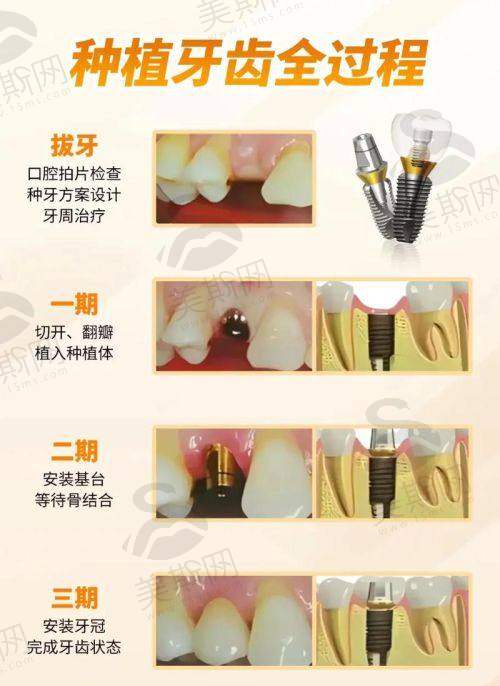 上海活动假牙医院口碑实例分享