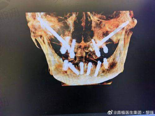 总结