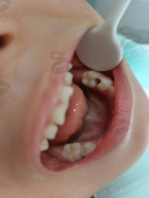 泸县补牙哪个医院比较好