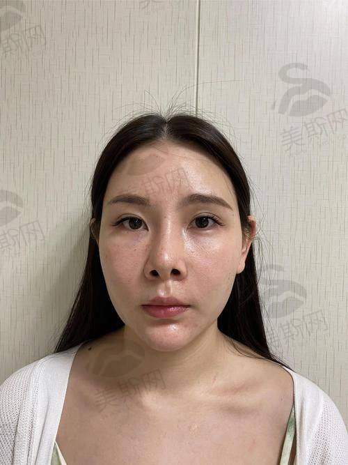 广州鼻修复最厉害三个医生是谁？罗延平、李文峰、金孝宪技术口碑兼具超靠谱！ 
