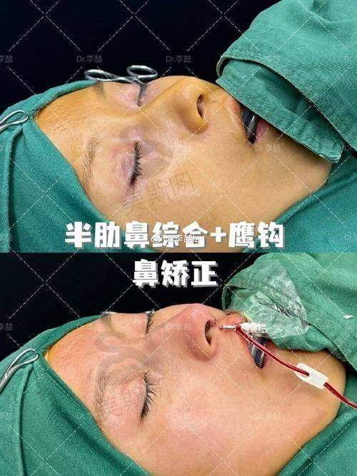 鼻修复关键选择点