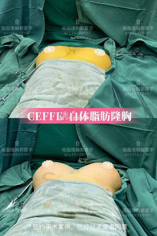 郭震宇自体脂肪丰胸技术优势