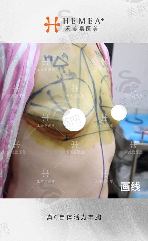 郭震宇自体脂肪丰胸收费标准解析