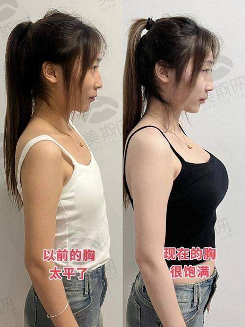 郭震宇自体脂肪丰胸口碑实例