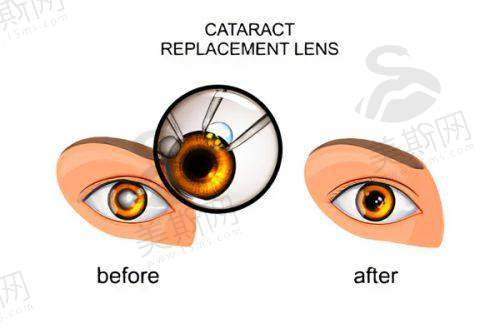 五、德州爱尔眼科医院诊疗项目