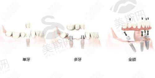 实例二:隐适美矫正,28岁白领告别龅牙