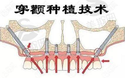 江苏南通摩尔口腔医院真人口碑实例反馈