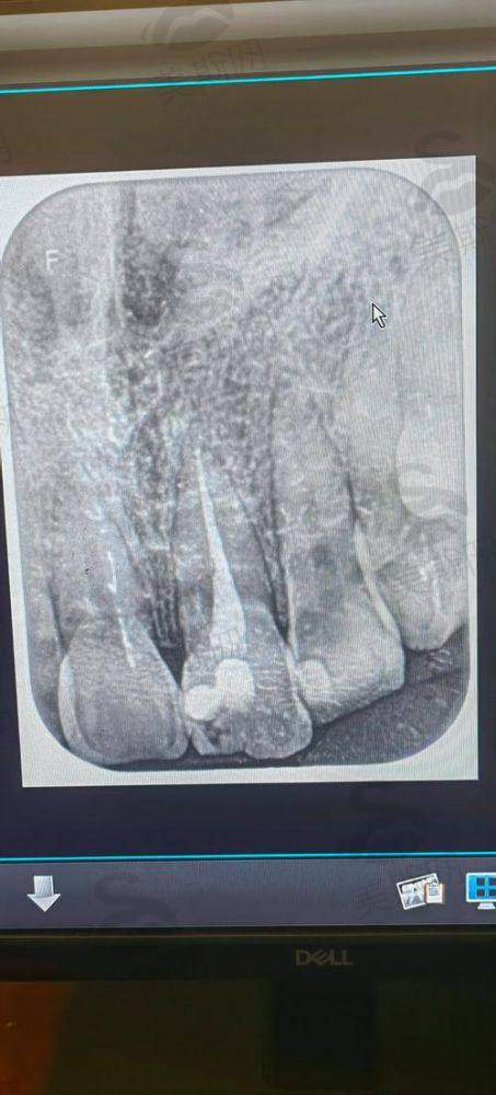 河南焦作植得口腔医院真人口碑实例反馈