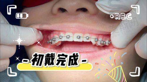 四川达州医大口腔医院真人口碑实例反馈
