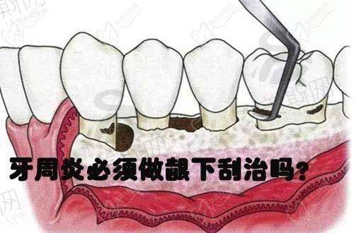 2. 数字化种植导航系统:精细度达0.1mm