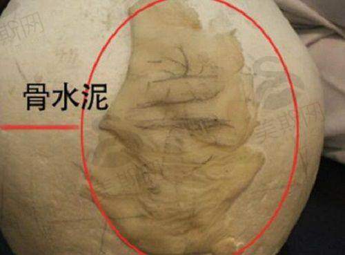 荆门超龙医疗美容门诊部假体隆鼻4000元起、去眼袋2000元起等项目价格大公开